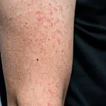 Saúde de Três Lagoas alerta sobre importância da vacinação contra o sarampo para viajantes internacionais