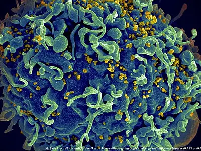 Paciente teria se curado do HIV com imunidade natural
